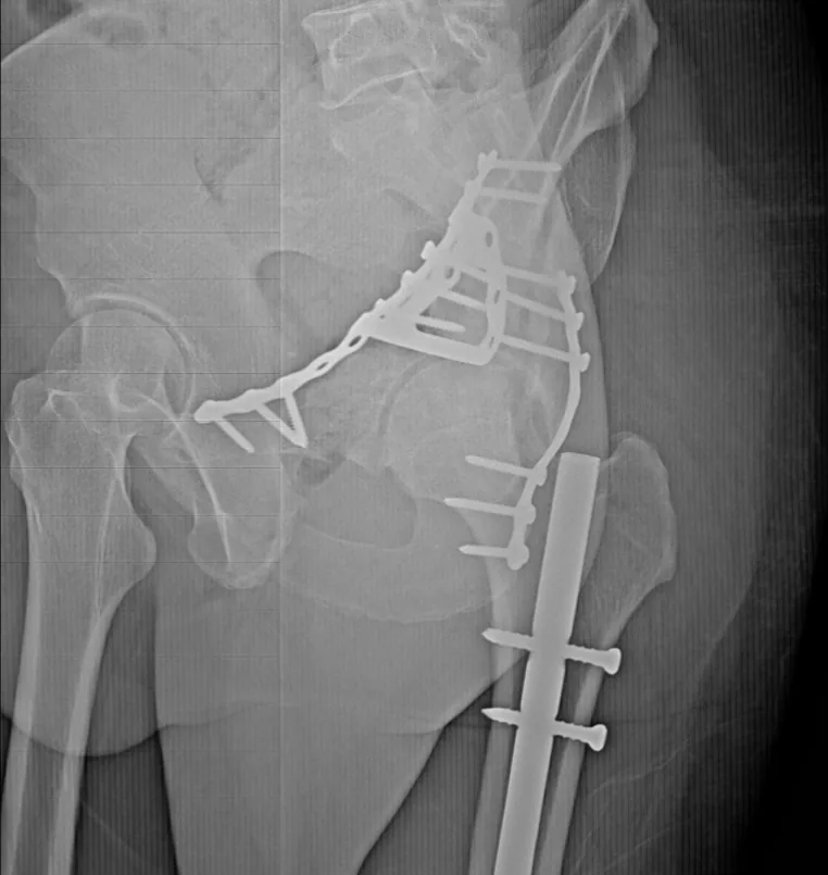 Acetabular fracture surgical fixation, orthopaedic trauma