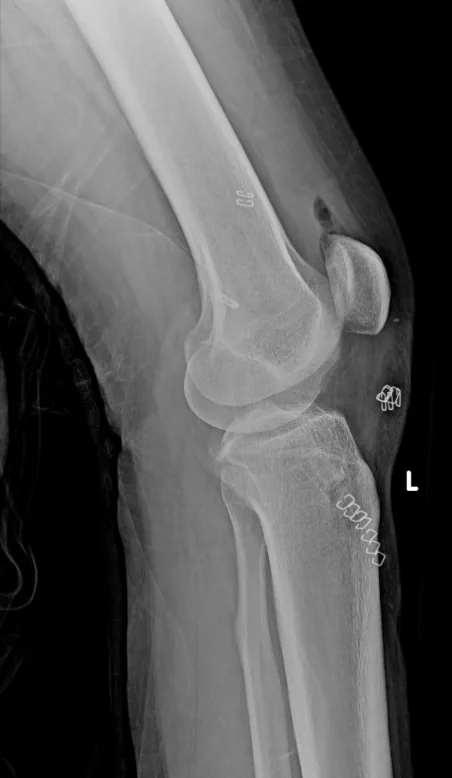 ACL reconstruction augmentation technique, arthroscopic view