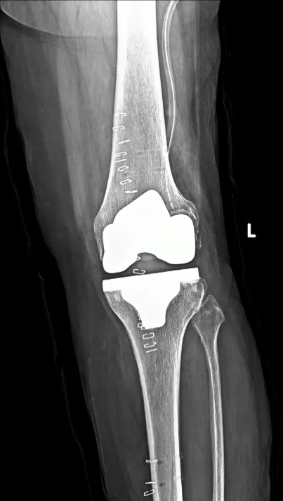Robotic knee replacement three-dimensional planning, MAKO Stryker system