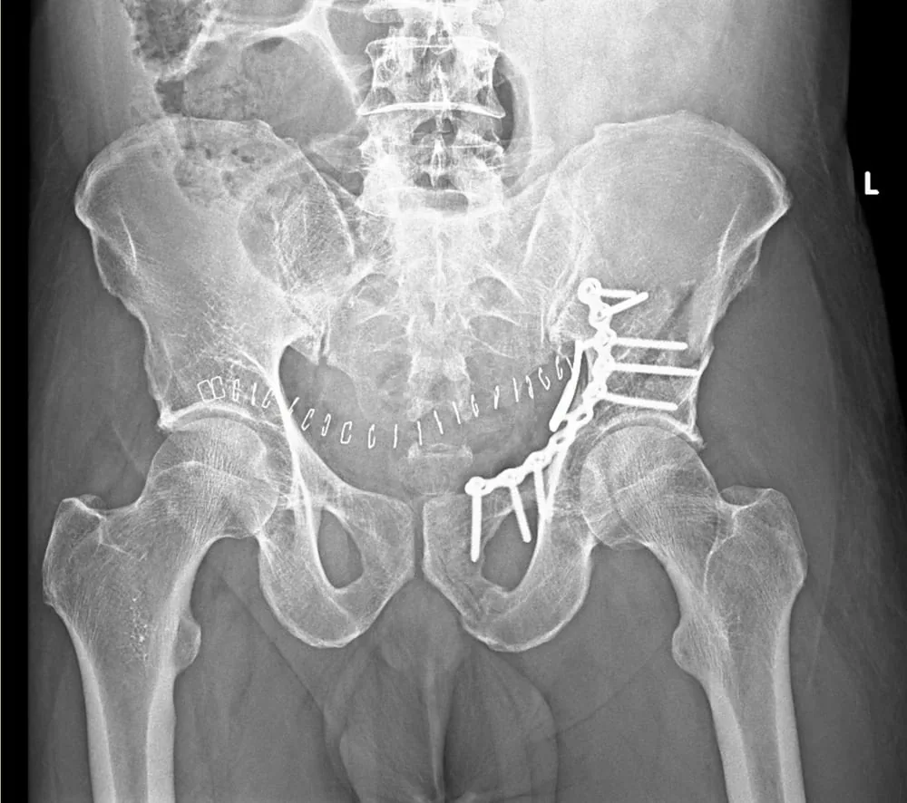 Complex pelvic fracture management, orthopaedic trauma surgery